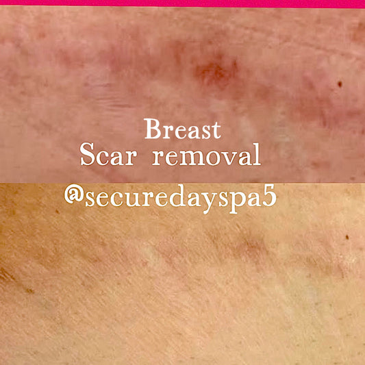 Scar cream